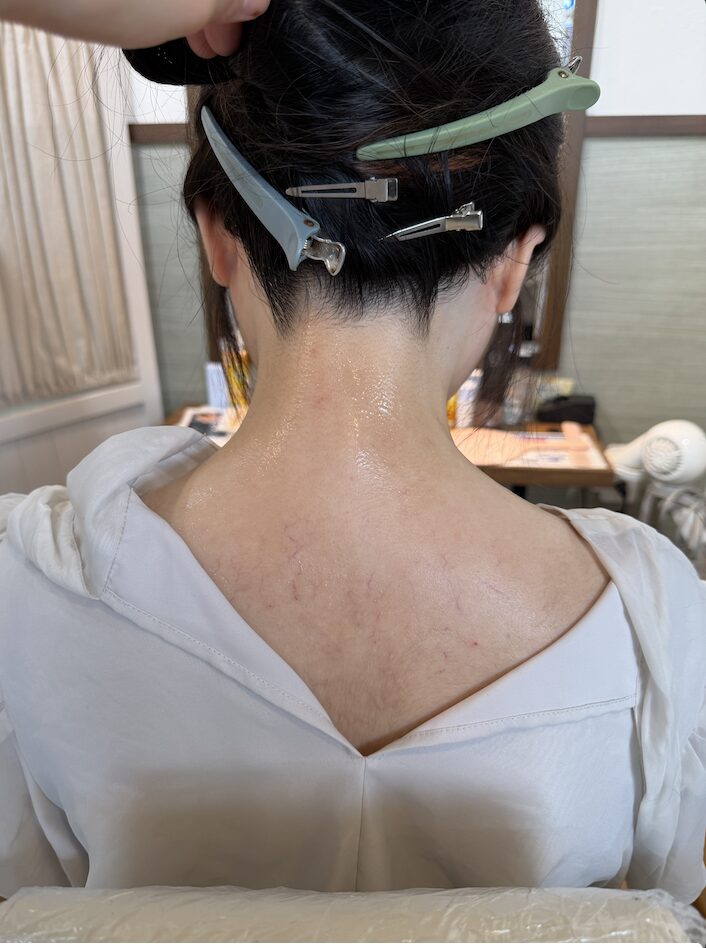 うなじ脱毛