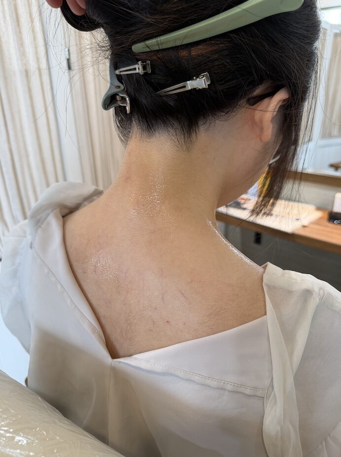 うなじ脱毛