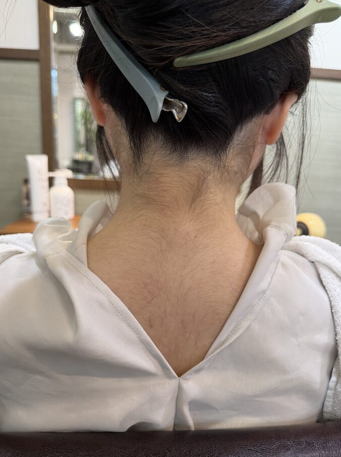 うなじ脱毛